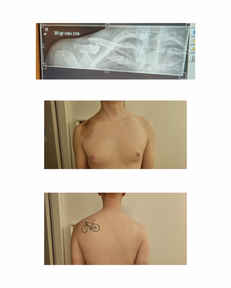 Clavicula fractuur